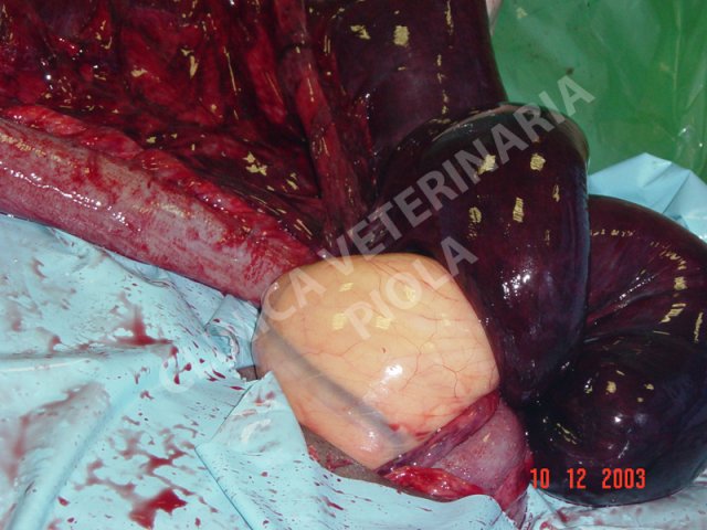 Strangolamento da lipoma peduncolato 3